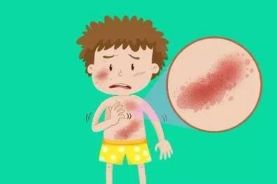 蕁麻疹的分類(lèi)有哪些?哪些食物會(huì)引起蕁麻疹?