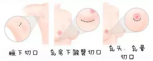 很瘦的女性假體豐胸如何選擇假體大。