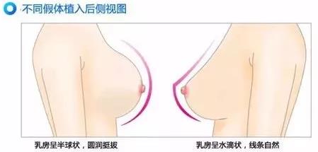 很瘦的女性假體豐胸如何選擇假體大?