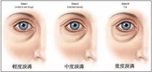 寧波薇琳整形醫(yī)院好嗎:玻尿酸填充淚溝,并不是打一針那么簡單