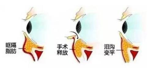 寧波薇琳整形醫(yī)院好嗎:玻尿酸填充淚溝,并不是打一針那么簡單