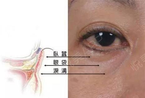 寧波薇琳整形醫(yī)院好嗎:玻尿酸填充淚溝,并不是打一針那么簡單