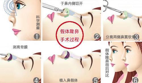寧波薇琳是正規(guī)醫(yī)院嗎:墊鼻梁用什么材料好?有沒有副作用?