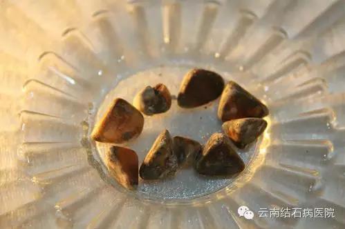 護(hù)膽聯(lián)盟:云南結(jié)石病醫(yī)院高三老師帶石教學(xué)兩年后取出9顆膽結(jié)石