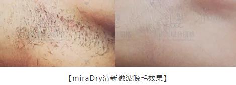 秒殺腋臭手術(shù)的止汗凈味黑科技——miraDry清新微波!