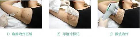 秒殺腋臭手術(shù)的止汗凈味黑科技——miraDry清新微波!