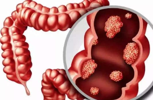 引發(fā)結(jié)腸息肉的因素有哪些?結(jié)腸息肉有哪些治療方式?