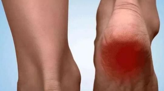 腳后跟疼怎么辦?腳后跟疼的原因有哪些?