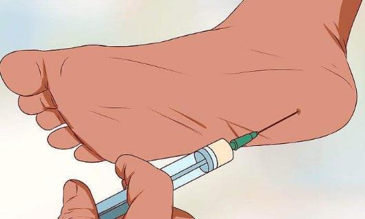 腳后跟疼有哪些治療方式?腳后跟疼吃什么好?