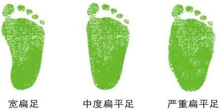 扁平足可以手術(shù)治療嗎?扁平足有哪些危害?