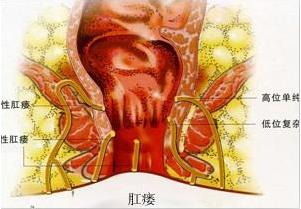 武漢漢西博仕肛腸醫(yī)院有這5個異常很可能中了肛瘺的招