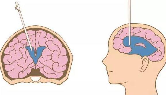 腦積水的治療方式有哪些?腦積水治療后需要補(bǔ)充哪些營(yíng)養(yǎng)?
