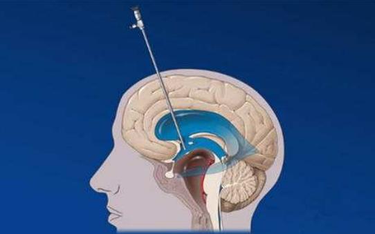 腦積水的病因有哪些?患腦積水有哪些癥狀?