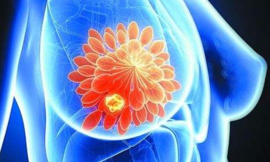 乳腺癌手術(shù)后需要注意什么?怎么預(yù)防乳腺癌?