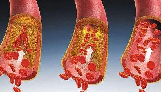 糖尿病性腎病的癥狀有哪些?糖尿病性腎病需要做哪些檢查?