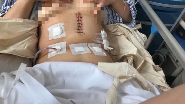 重慶南川宏仁一醫(yī)院:普外科完成首例腹腔鏡輔助胃癌根治術(shù)