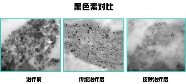 杭州瑞麗小課堂|拒絕加\"斑\",皮秒/超皮秒來了