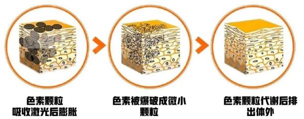 杭州瑞麗小課堂|拒絕加\"斑\",皮秒/超皮秒來了