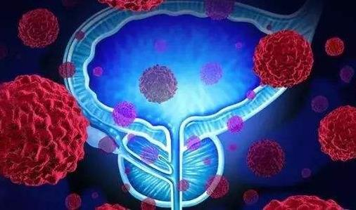 患前列腺癌的病因有哪些?前列腺癌有哪些并發(fā)癥?