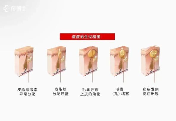 博士說(shuō)痘||直擊痘痘的老巢 細(xì)胞在毛囊漏斗部變身痘痘——細(xì)說(shuō)細(xì)胞祛痘之四