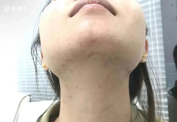 最美教師蒞臨|| 痘博士百余家門店因教師節(jié)公益活動引爆!