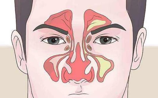 鼻竇炎有哪些疾病分類?引起鼻竇炎的原因有哪些?