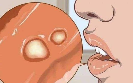 什么是白塞?白塞病有哪些癥狀?