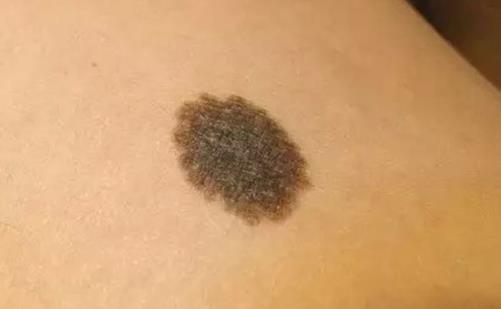 色素痣有哪些分類?怎么預(yù)防色素痣?