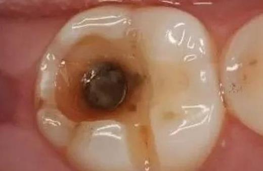 患蛀牙的原因有哪些?患蛀牙的癥狀有哪些?