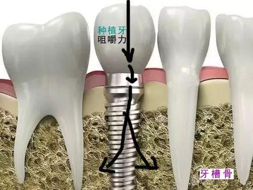 全民愛牙公益行動種植牙與陶瓷牙哪個好