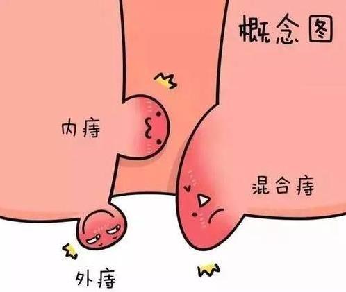 內(nèi)痔瘡怎么治好得快?內(nèi)痔瘡的最佳治療方法用什么藥膏