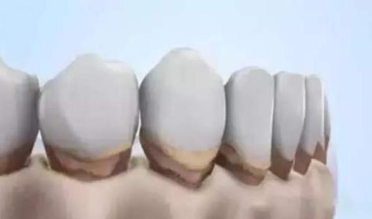 引起牙齦萎縮的原因有哪些?牙齦萎縮吃什么好?
