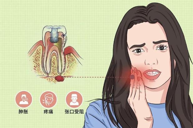 全民愛(ài)牙公益-智齒牙發(fā)炎有哪些炎癥呢