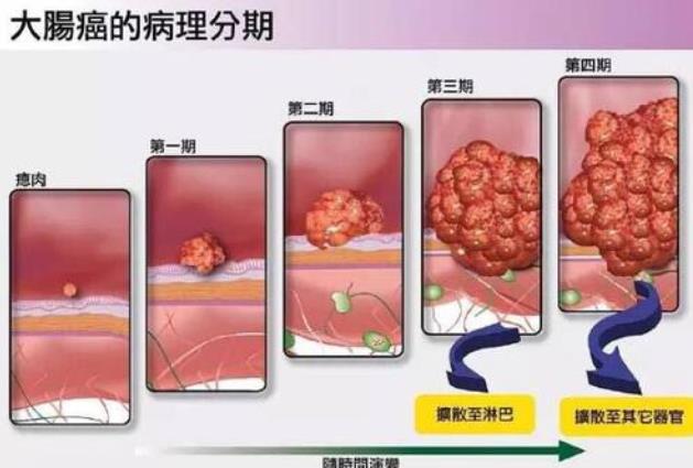 武漢漢西博仕肛腸醫(yī)院如廁三種表現(xiàn)或是腸道“長”息肉