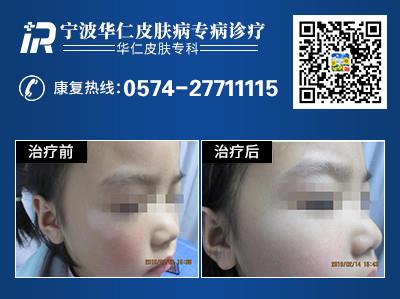 寧波白癜風(fēng)醫(yī)院:孩子是白癜風(fēng)易發(fā)群體嗎?