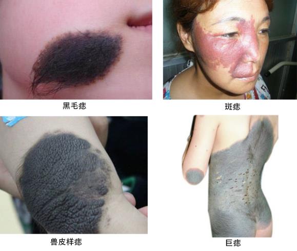 黑毛痣用激光好還是手術(shù)切除好?
