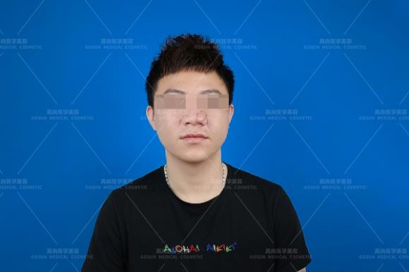 黑毛痣用激光好還是手術(shù)切除好?