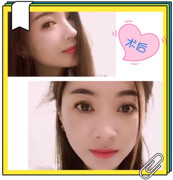 臉部脂肪填充效果如何 昆明吳氏嘉美整形醫(yī)院