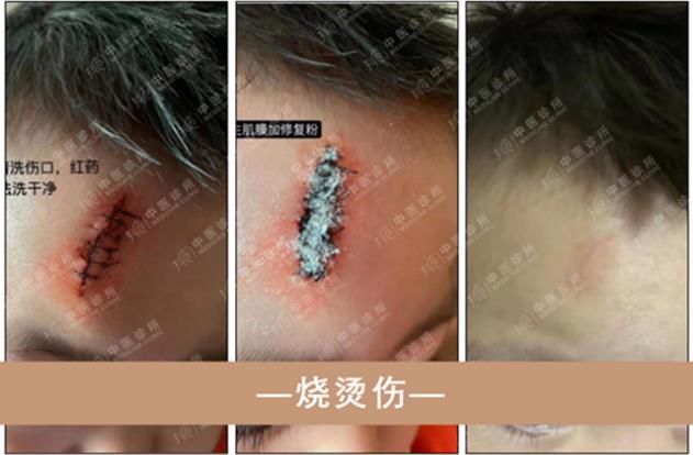 抖梵皙疤痕修護(hù)事業(yè)萬億市場來襲