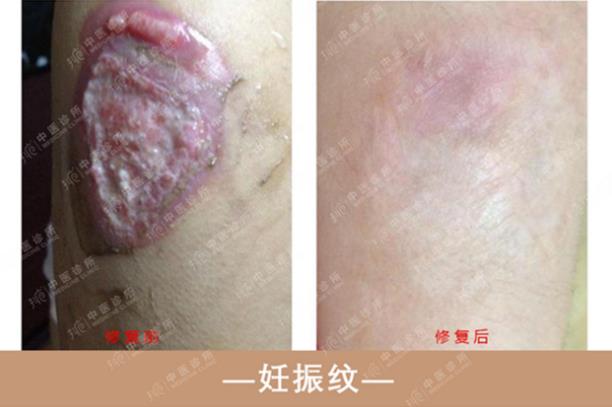 抖梵皙疤痕修護(hù)事業(yè)萬億市場來襲