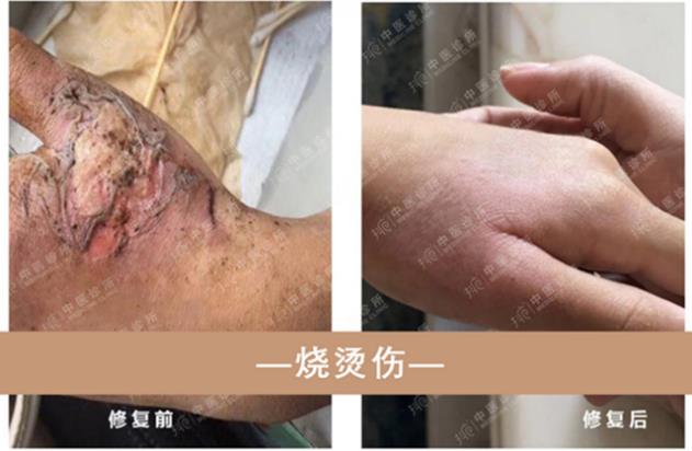 抖梵皙疤痕修護(hù)事業(yè)萬億市場來襲
