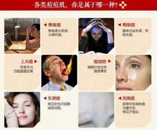 國產(chǎn)祛痘護(hù)膚品哪個好?到底哪種產(chǎn)品真正祛痘?