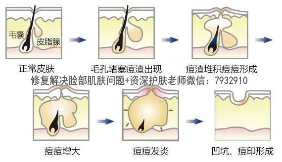 比較安全的祛痘印產(chǎn)品:朵嘉濃到底能修復(fù)皮膚嗎?