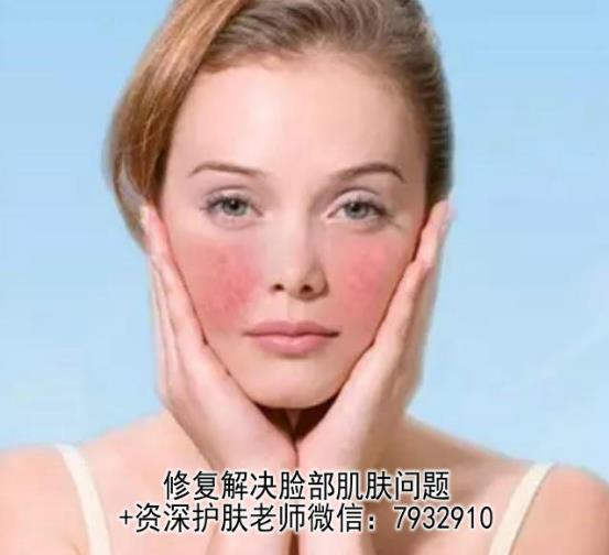 臉過(guò)敏嚴(yán)重紅腫怎么辦?朵嘉濃的護(hù)膚品真的能修復(fù)好皮膚嗎?