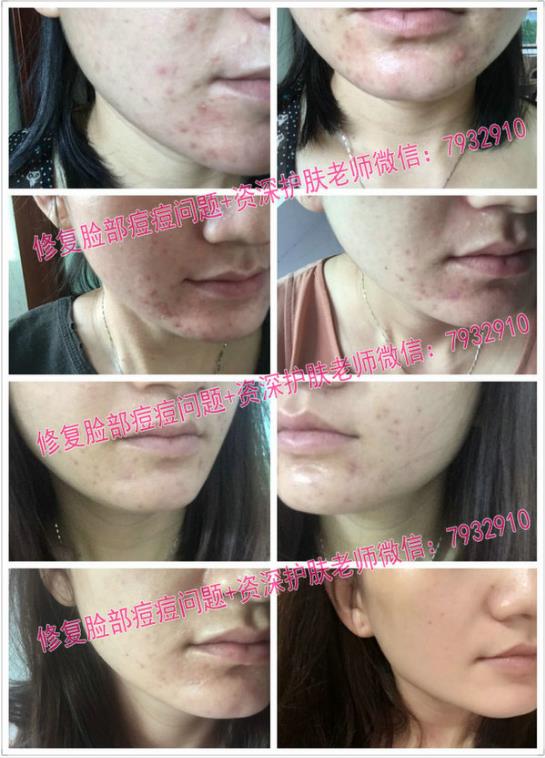 比較安全的祛痘印產(chǎn)品:朵嘉濃到底能修復(fù)皮膚嗎?