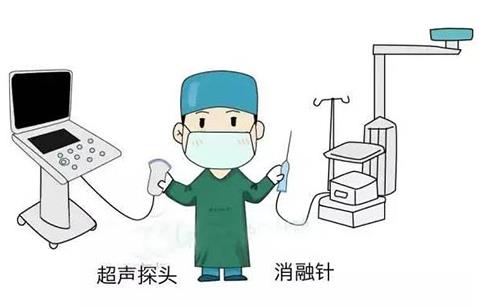 濟(jì)南顯微外科醫(yī)院為20歲甲狀腺結(jié)節(jié)患者消融治療,美觀無(wú)疤痕