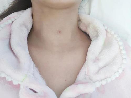 濟(jì)南顯微外科醫(yī)院為20歲甲狀腺結(jié)節(jié)患者消融治療,美觀無(wú)疤痕