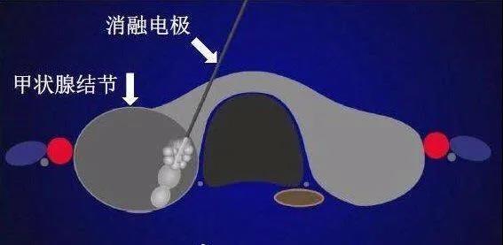 濟(jì)南顯微外科醫(yī)院為20歲甲狀腺結(jié)節(jié)患者消融治療,美觀無(wú)疤痕