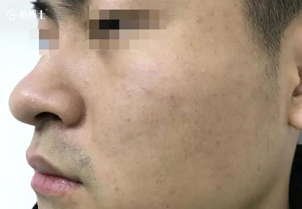 博士說(shuō)痘||博士總結(jié)出痘痘8種造坑大法!試看痘痘在老巢怎么作?——細(xì)說(shuō)細(xì)胞祛痘之六