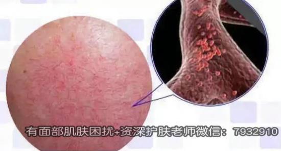 熬夜臉上有紅血絲咋辦?紅血絲能徹底去除嗎?